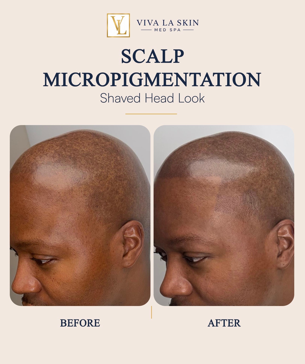 Scalp Micropigmentation before and after result at Viva La Skin Med Spa in Myrtle Beach