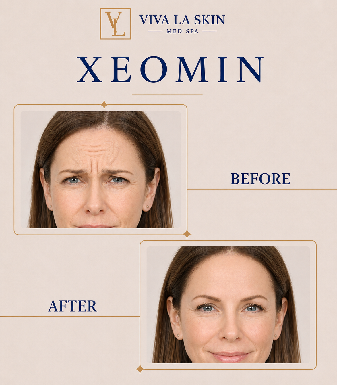 Xeomin before and after result at Viva La Skin Med Spa in Myrtle Beach