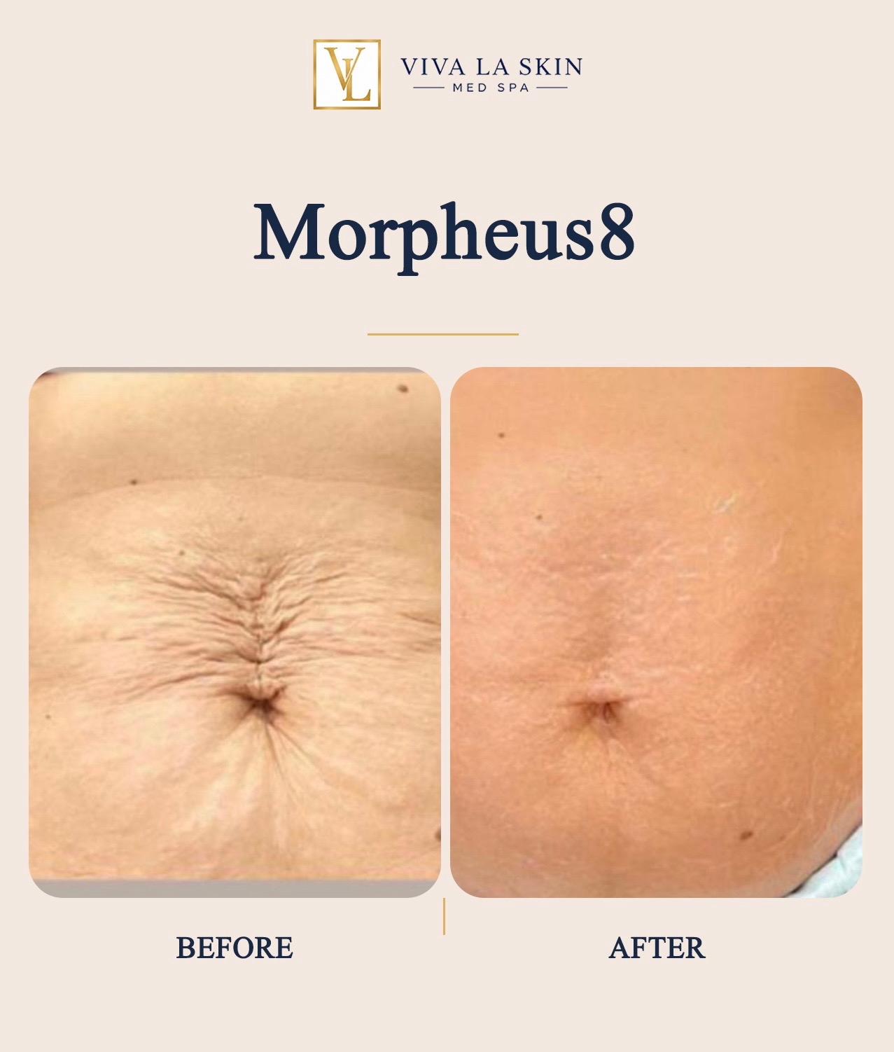 Morpheus8 before and after result at Viva La Skin Med Spa in Myrtle Beach
