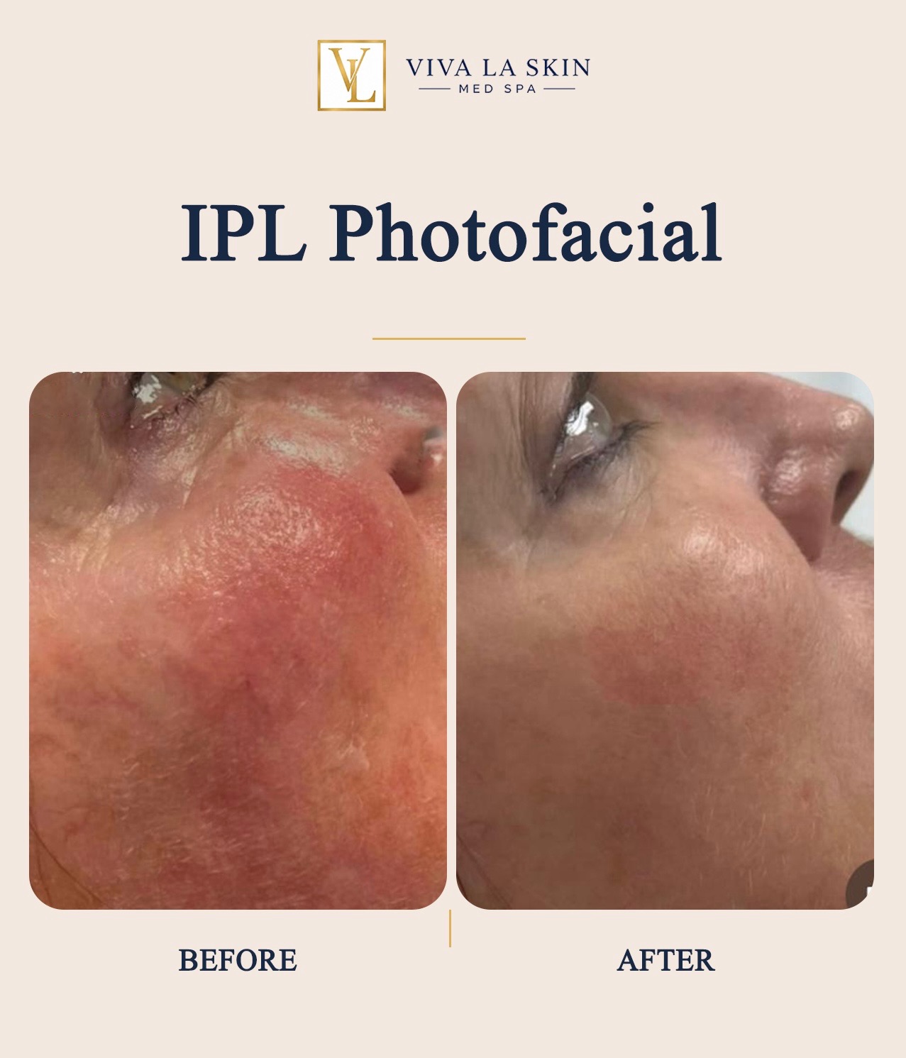 IPL Photofacial before and after result at Viva La Skin Med Spa in Myrtle Beach