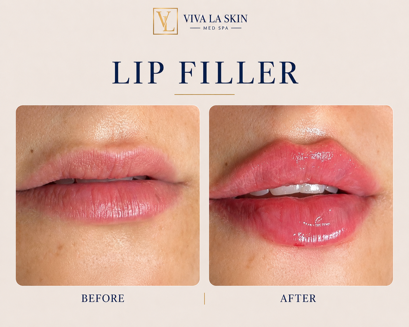 Filler before and after result at Viva La Skin Med Spa in Myrtle Beach