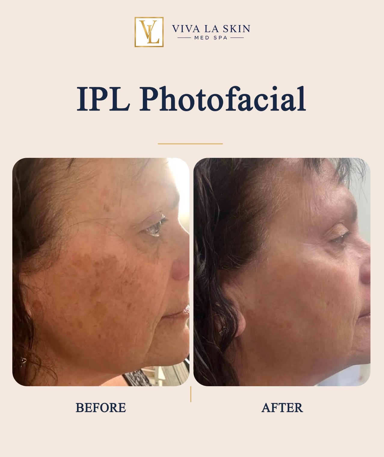 IPL Photofacial before and after result at Viva La Skin Med Spa in Myrtle Beach