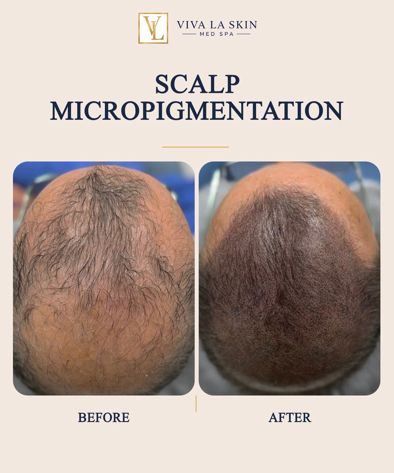 Scalp Micropigmentation before and after result at Viva La Skin Med Spa in Myrtle Beach