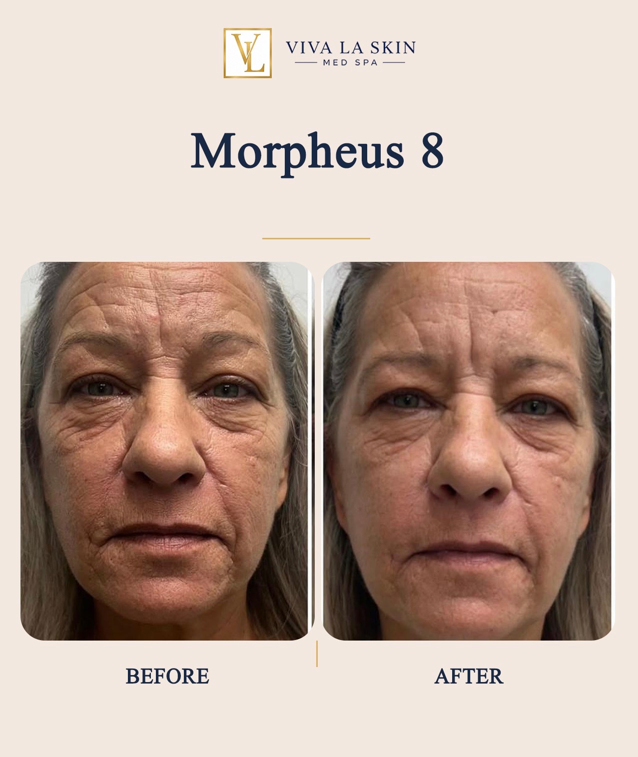 Morpheus8 before and after result at Viva La Skin Med Spa in Myrtle Beach