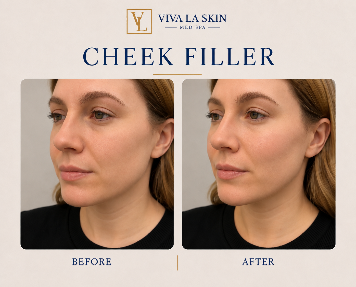 Filler before and after result at Viva La Skin Med Spa in Myrtle Beach