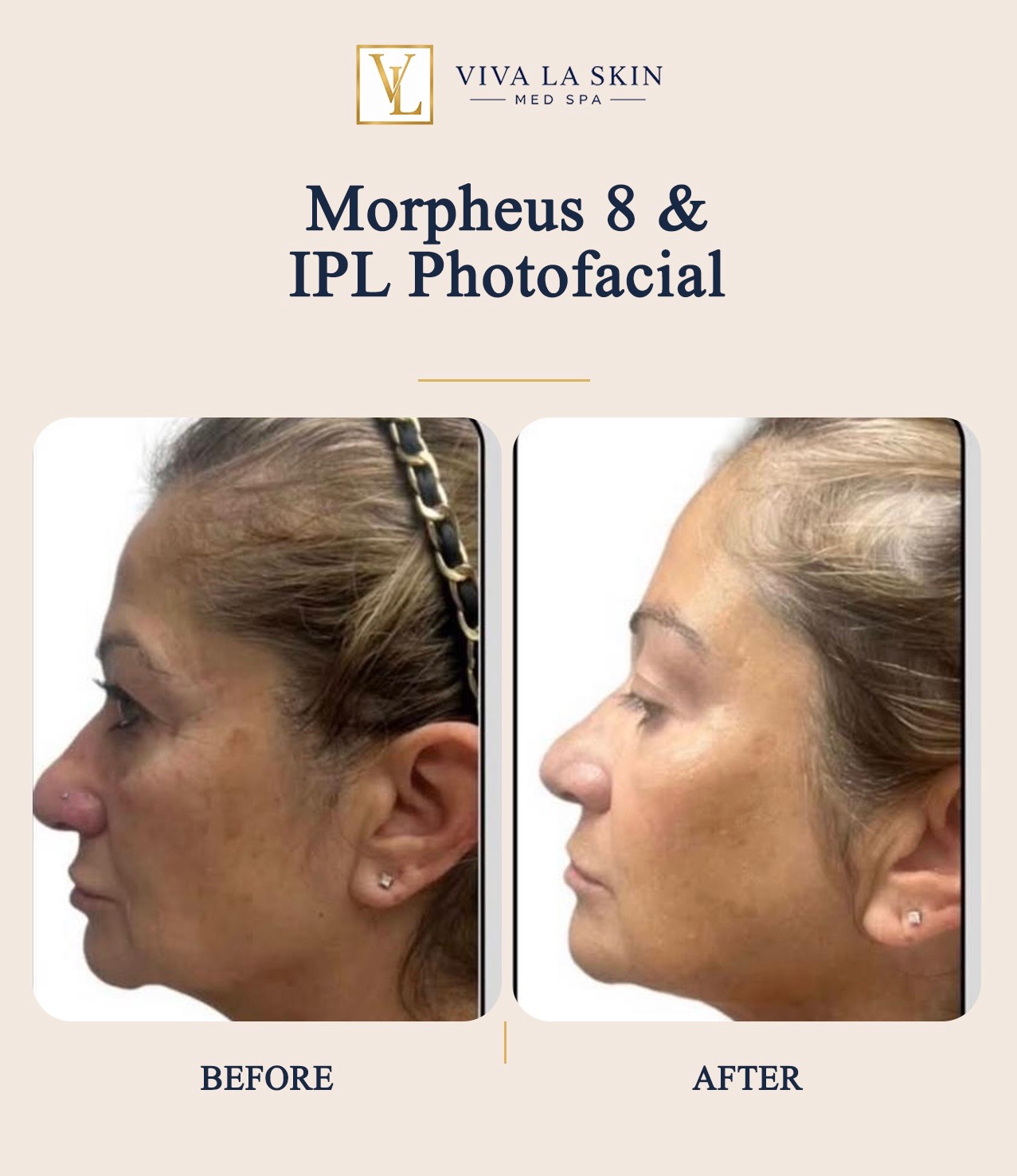 Morpheus8 before and after result at Viva La Skin Med Spa in Myrtle Beach