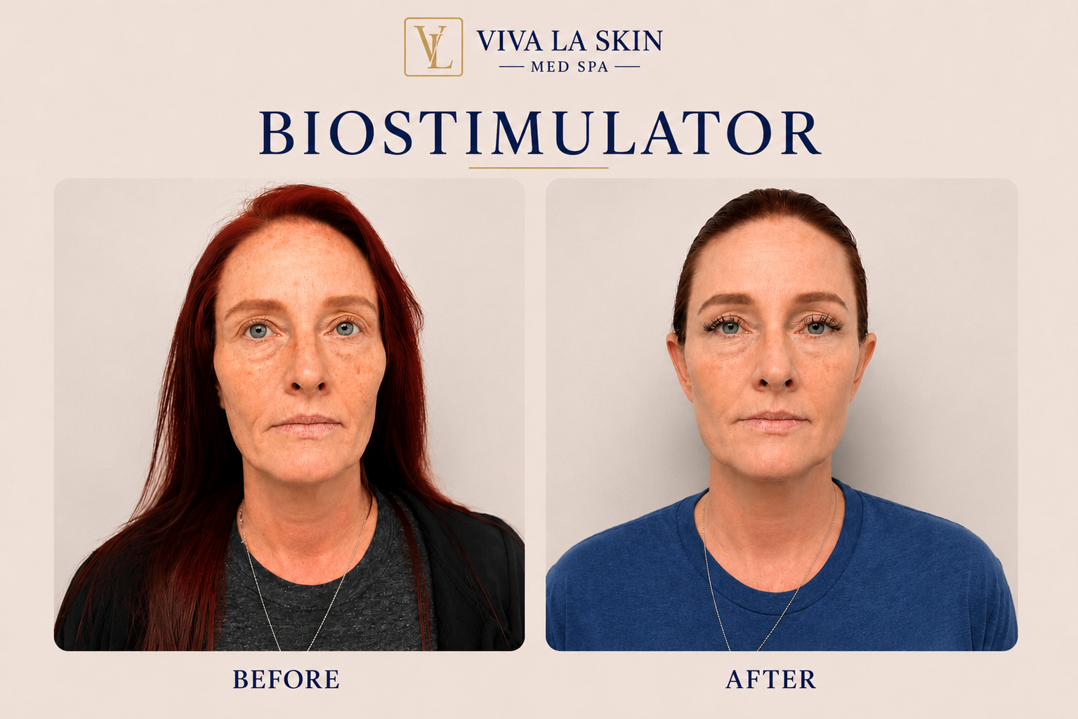 BioStimulator before and after result at Viva La Skin Med Spa in Myrtle Beach