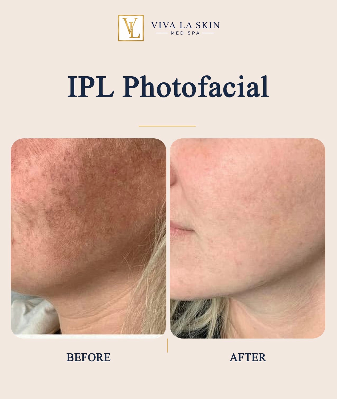 IPL Photofacial before and after result at Viva La Skin Med Spa in Myrtle Beach