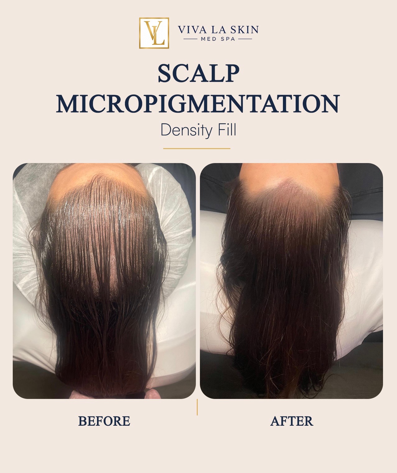 Scalp Micropigmentation before and after result at Viva La Skin Med Spa in Myrtle Beach