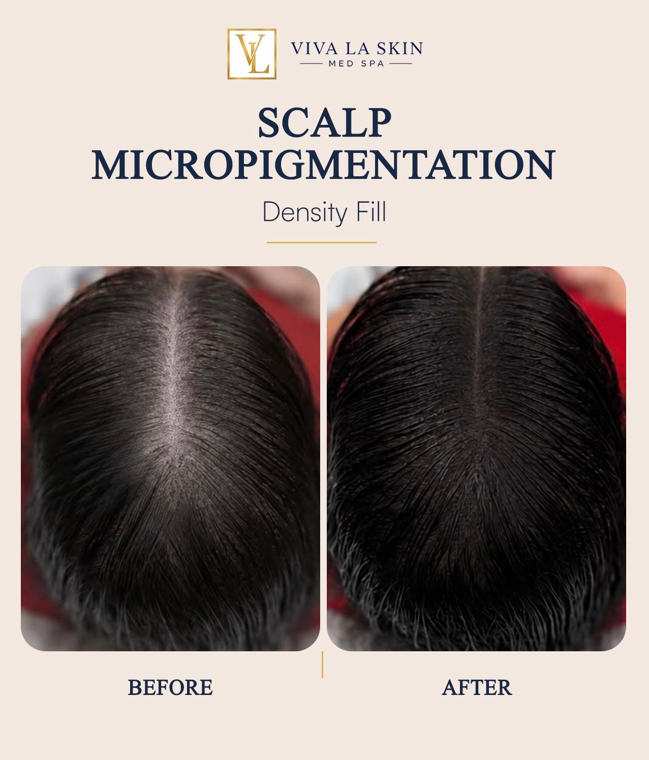Scalp Micropigmentation before and after result at Viva La Skin Med Spa in Myrtle Beach
