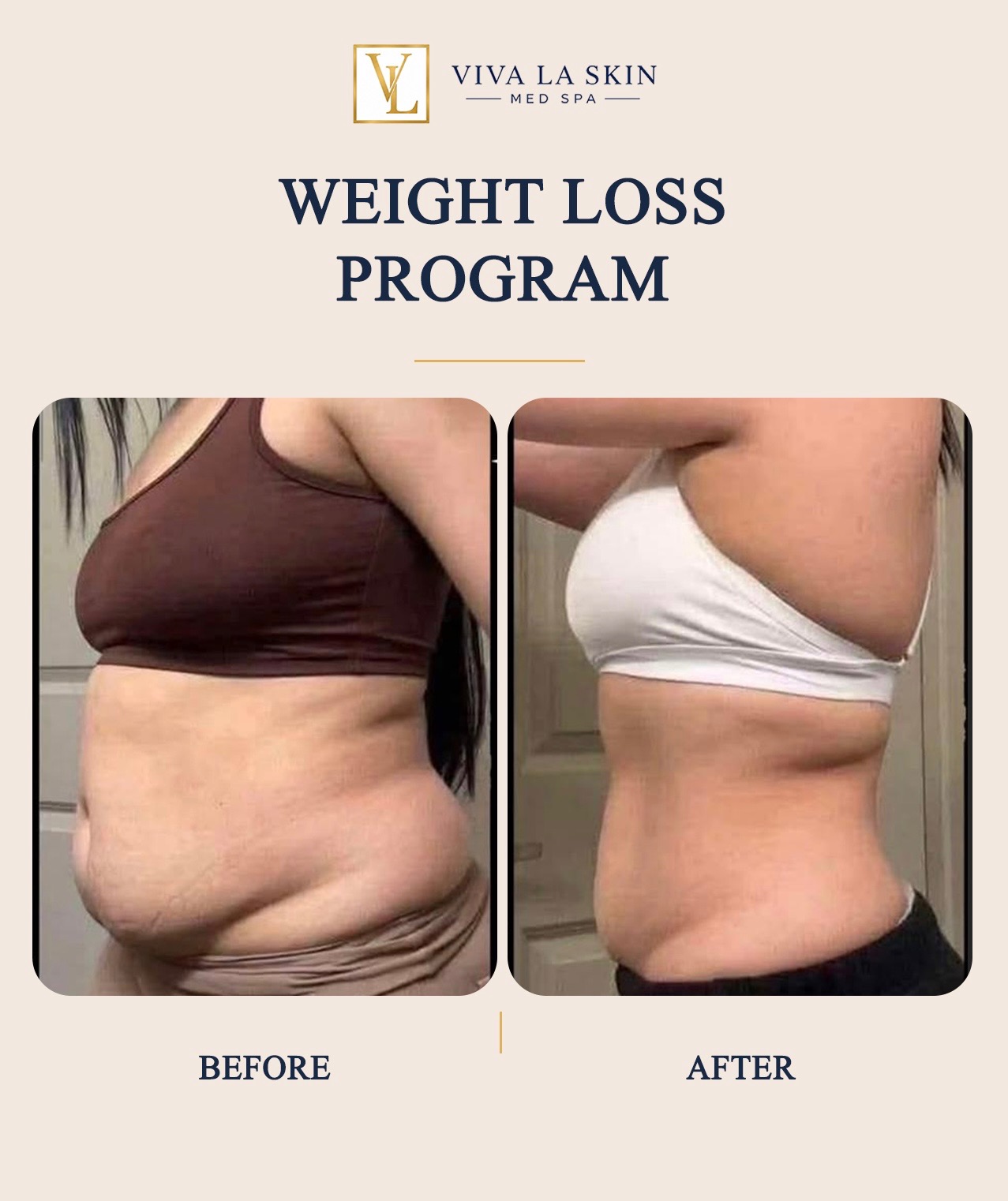 Weight Loss Program before and after result at Viva La Skin Med Spa in Myrtle Beach