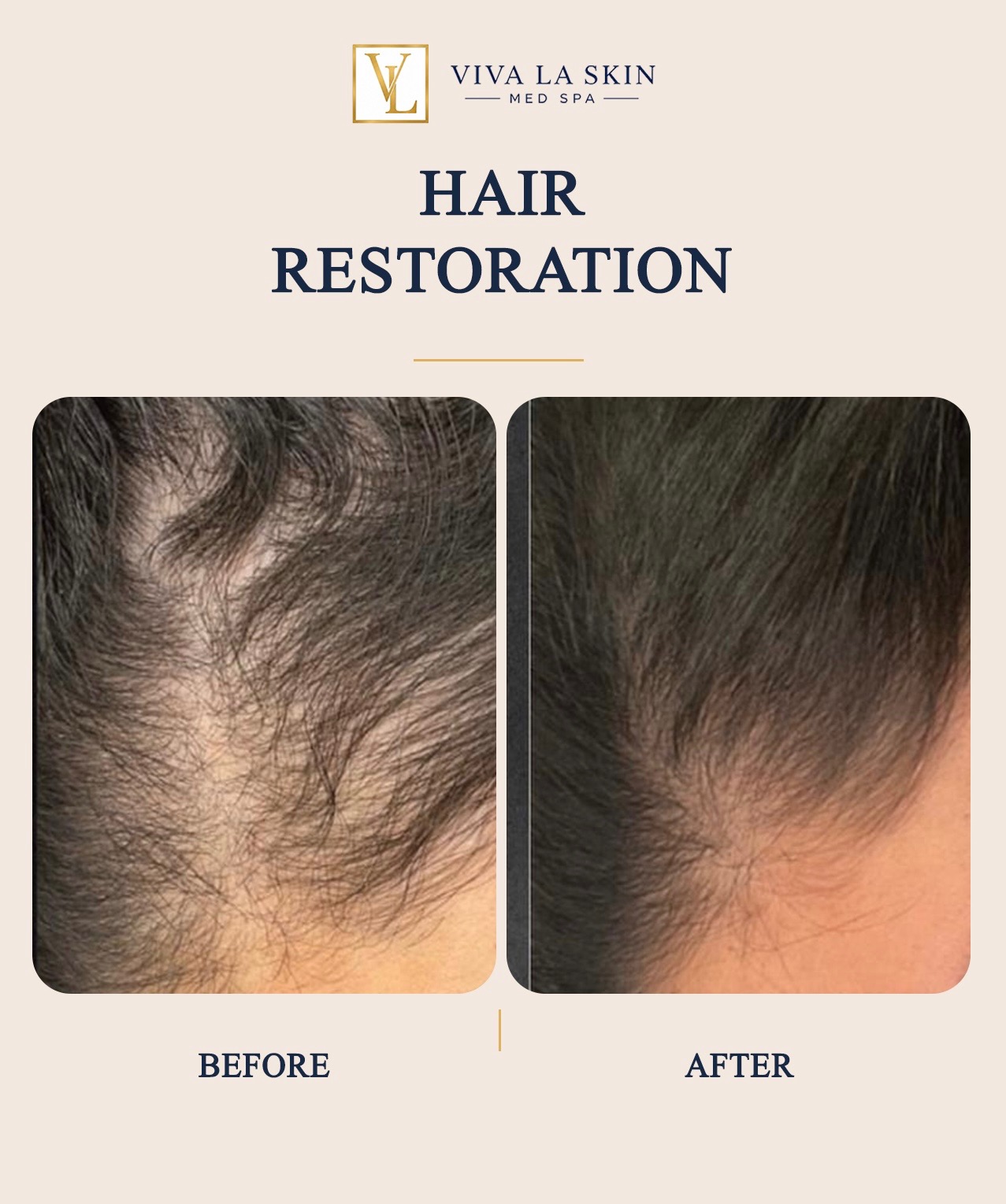 Hair Restoration before and after result at Viva La Skin Med Spa in Myrtle Beach
