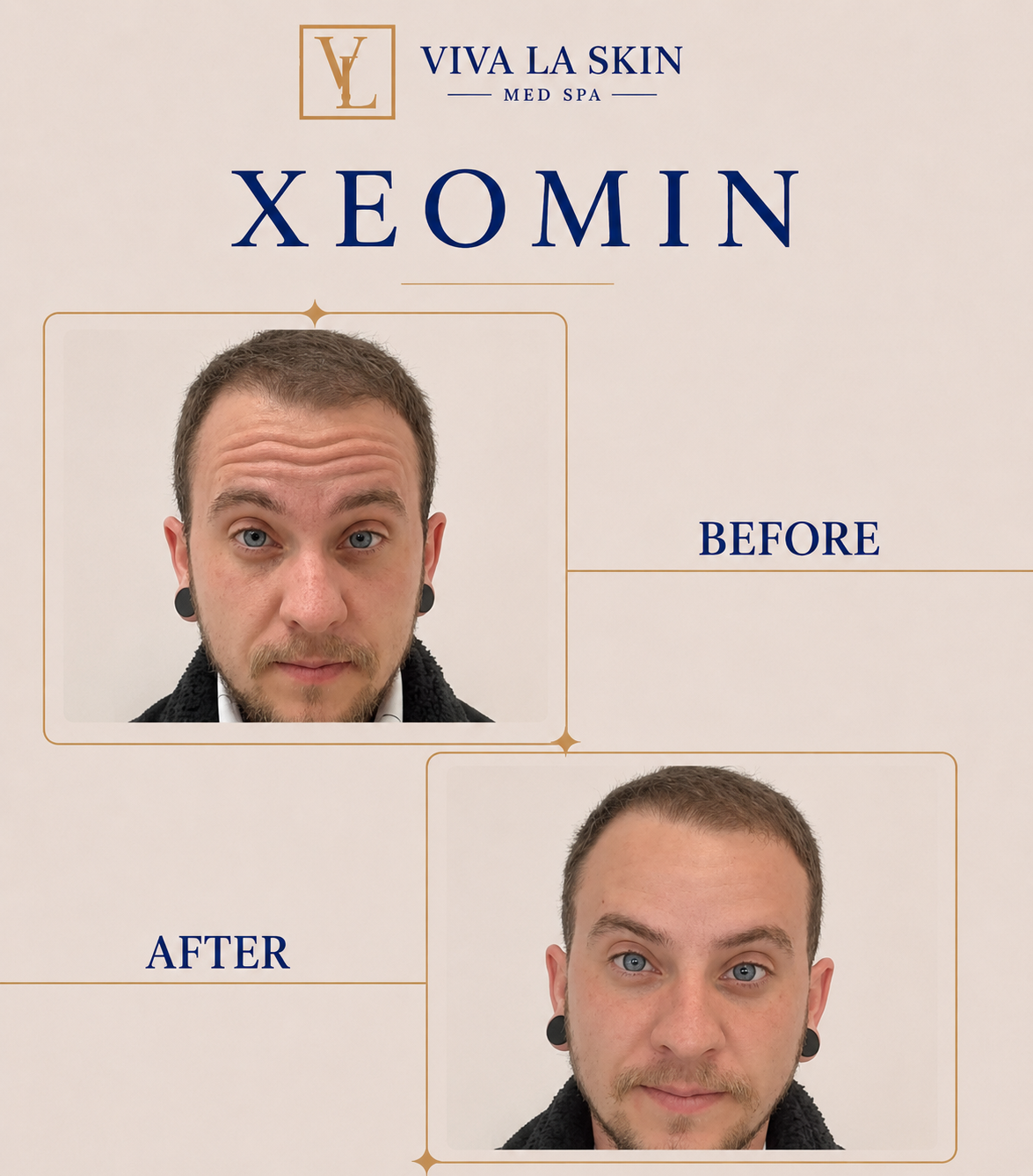 Xeomin before and after result at Viva La Skin Med Spa in Myrtle Beach