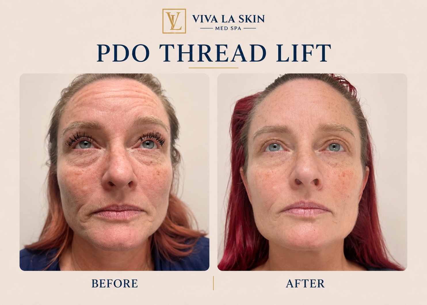 PDO Threads before and after result at Viva La Skin Med Spa in Myrtle Beach