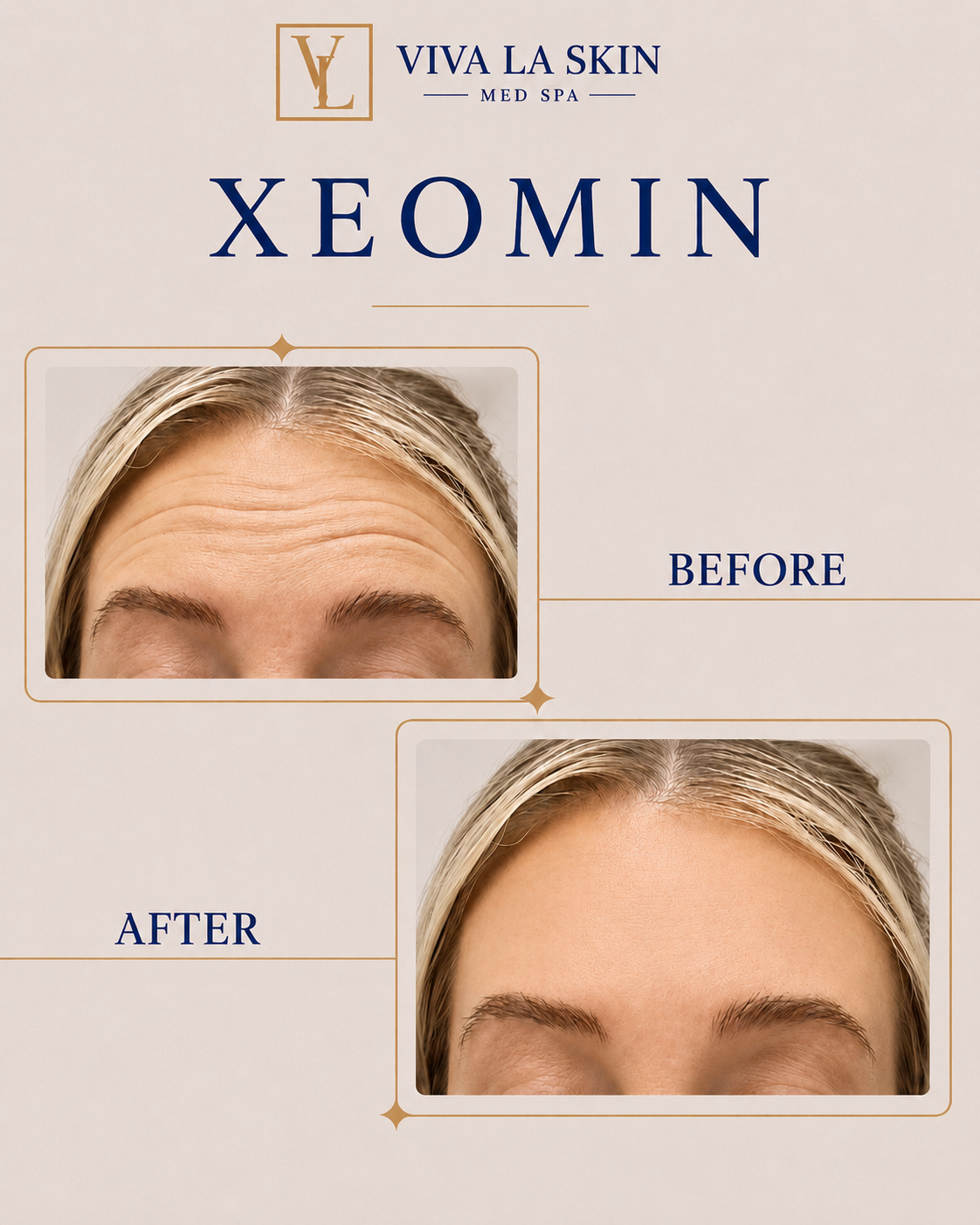 Xeomin before and after result at Viva La Skin Med Spa in Myrtle Beach
