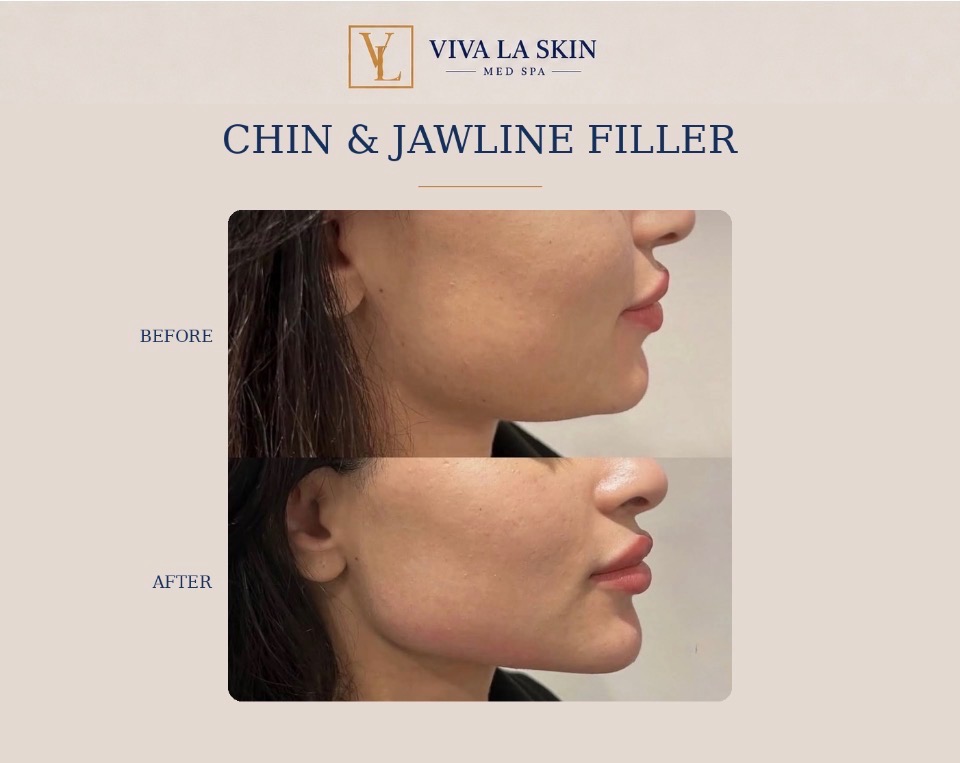 Filler before and after result at Viva La Skin Med Spa in Myrtle Beach