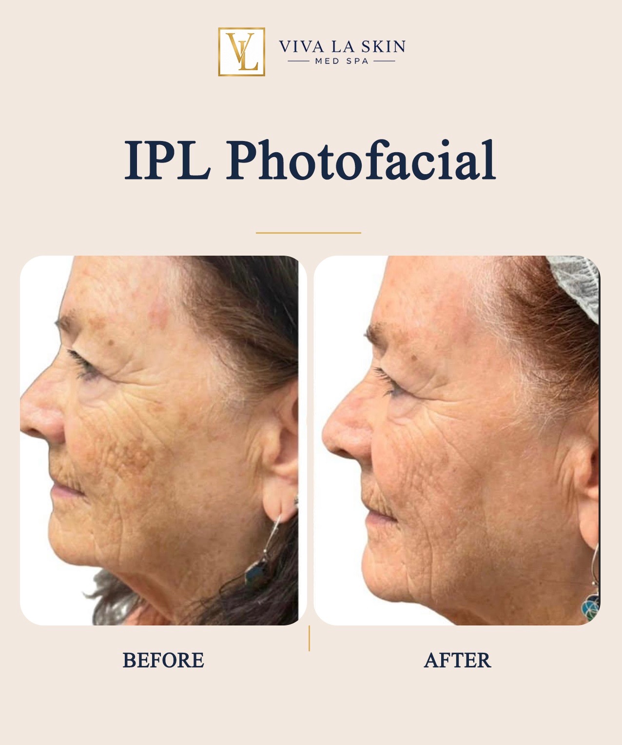 IPL Photofacial before and after result at Viva La Skin Med Spa in Myrtle Beach