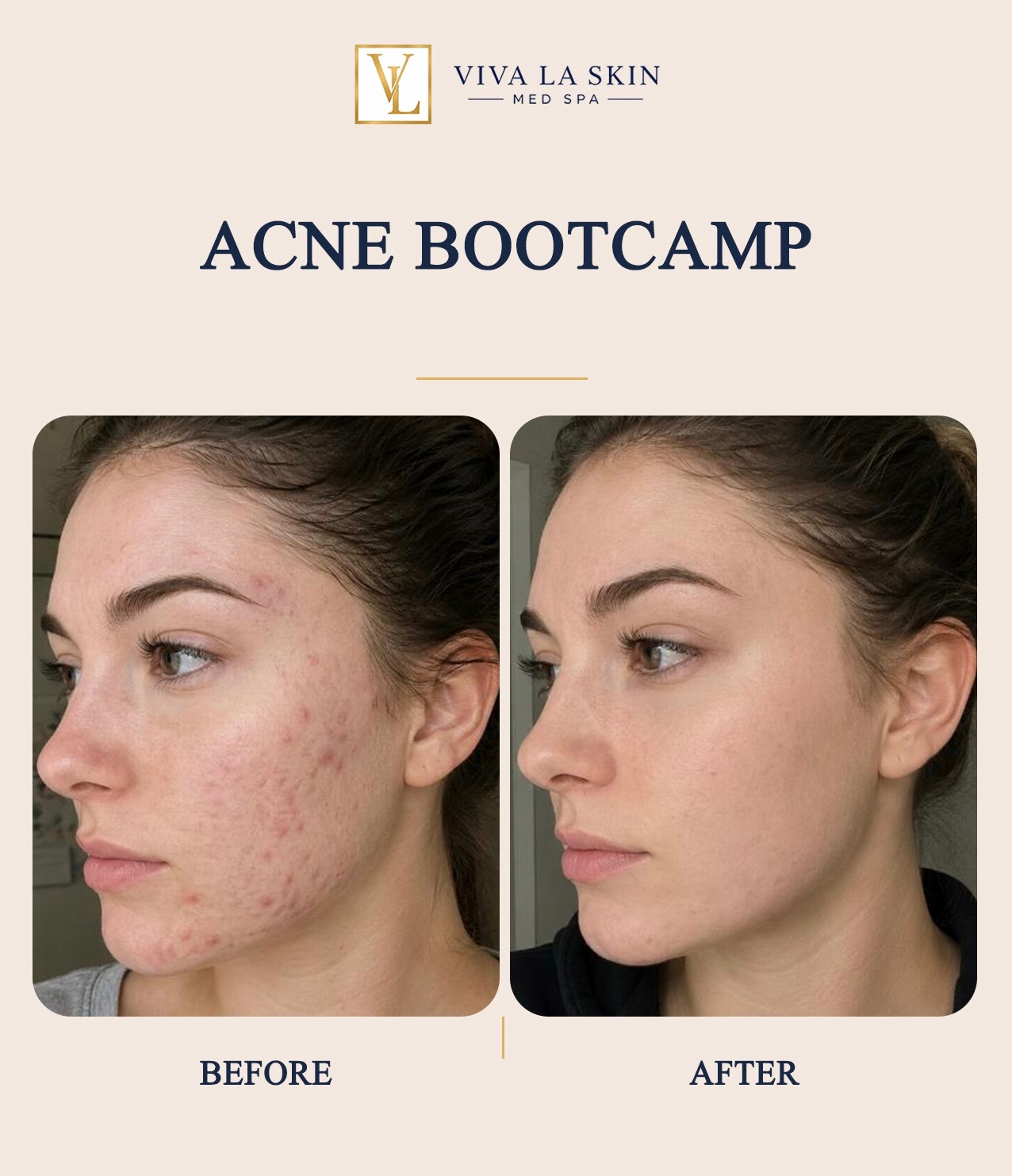 Acne Bootcamp before and after result at Viva La Skin Med Spa in Myrtle Beach