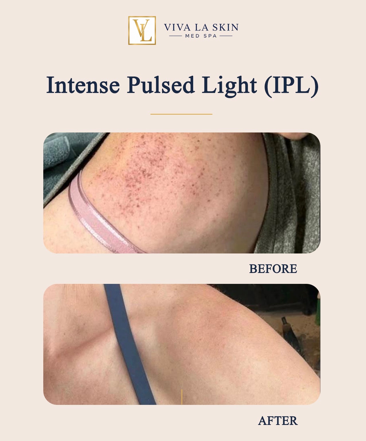 IPL Photofacial before and after result at Viva La Skin Med Spa in Myrtle Beach