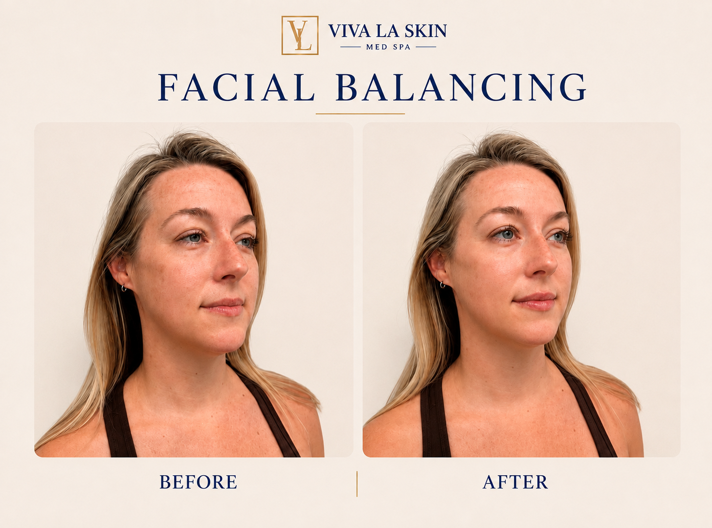 Facial Balancing before and after result at Viva La Skin Med Spa in Myrtle Beach