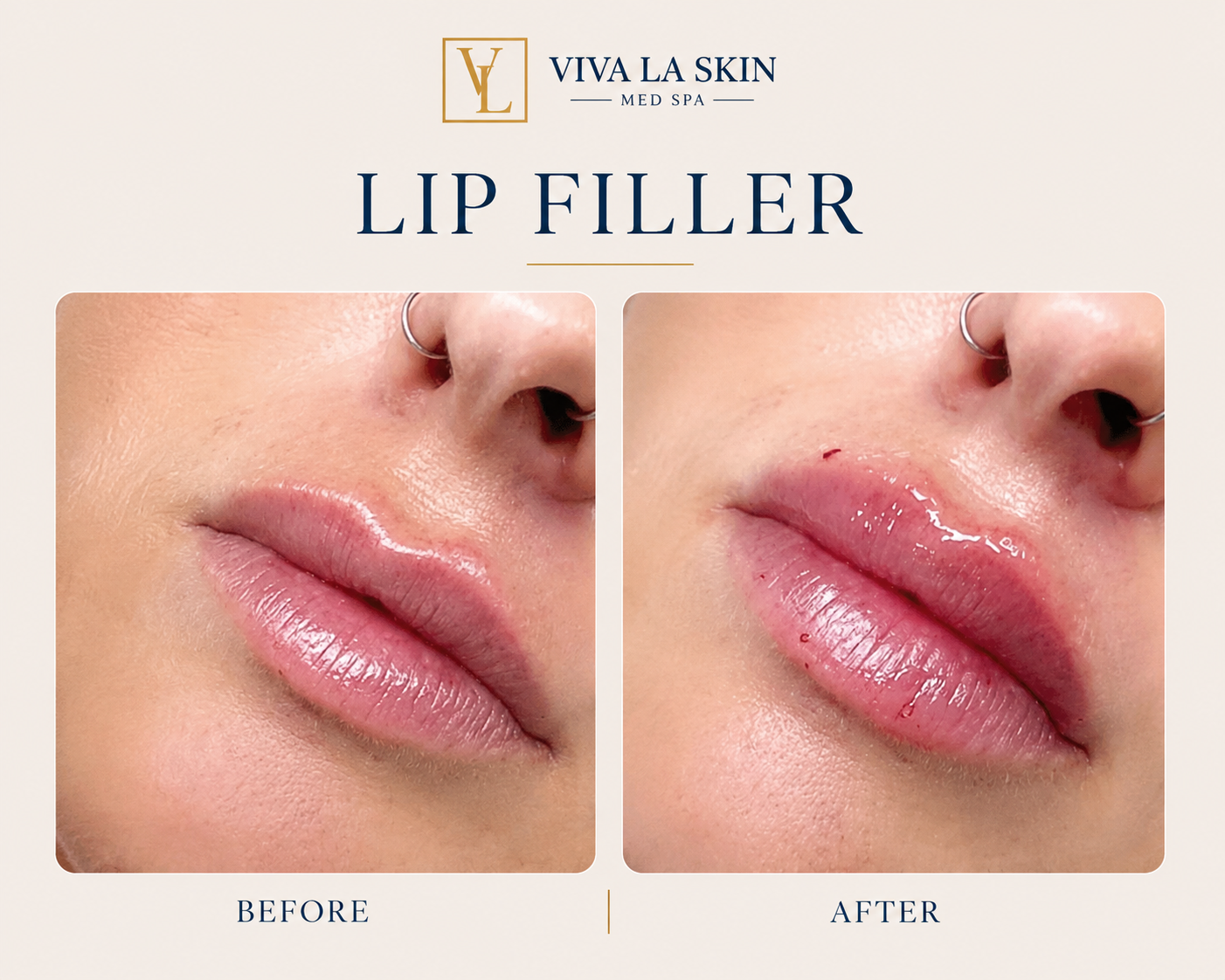 Filler before and after result at Viva La Skin Med Spa in Myrtle Beach