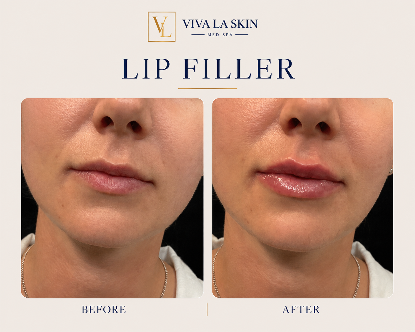 Filler before and after result at Viva La Skin Med Spa in Myrtle Beach