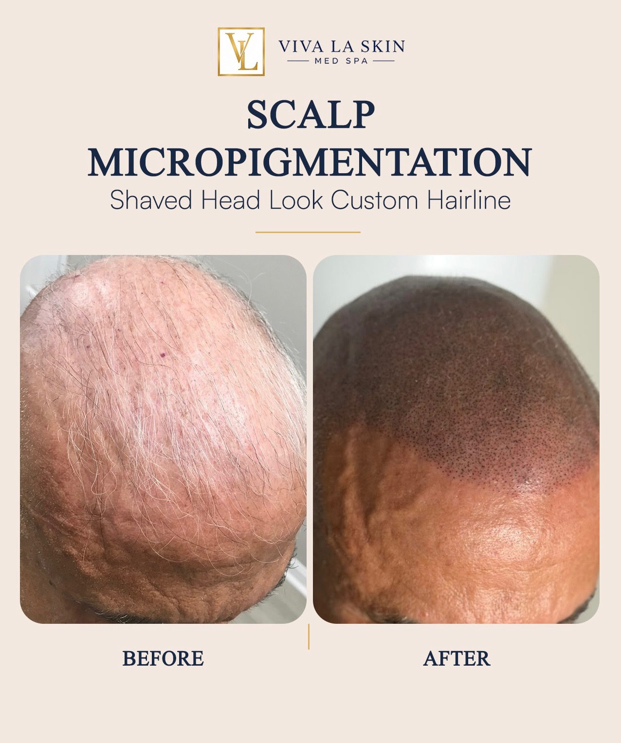 Scalp Micropigmentation before and after result at Viva La Skin Med Spa in Myrtle Beach