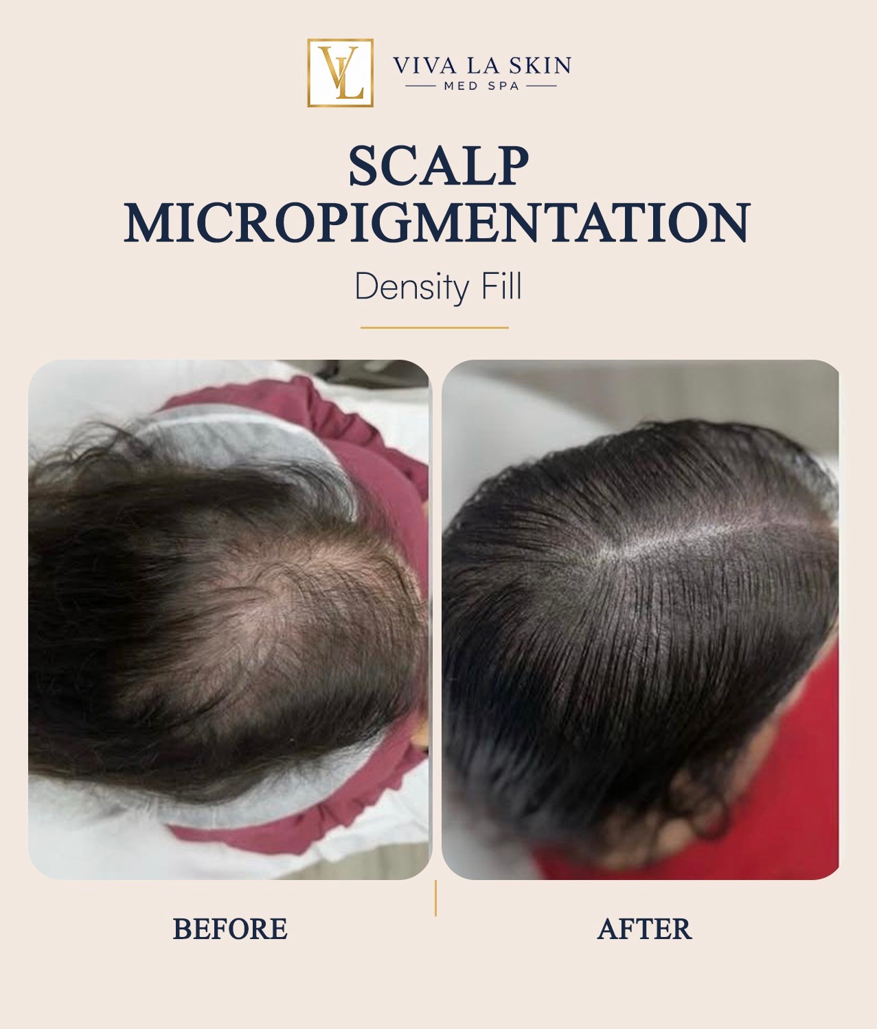 Scalp Micropigmentation before and after result at Viva La Skin Med Spa in Myrtle Beach