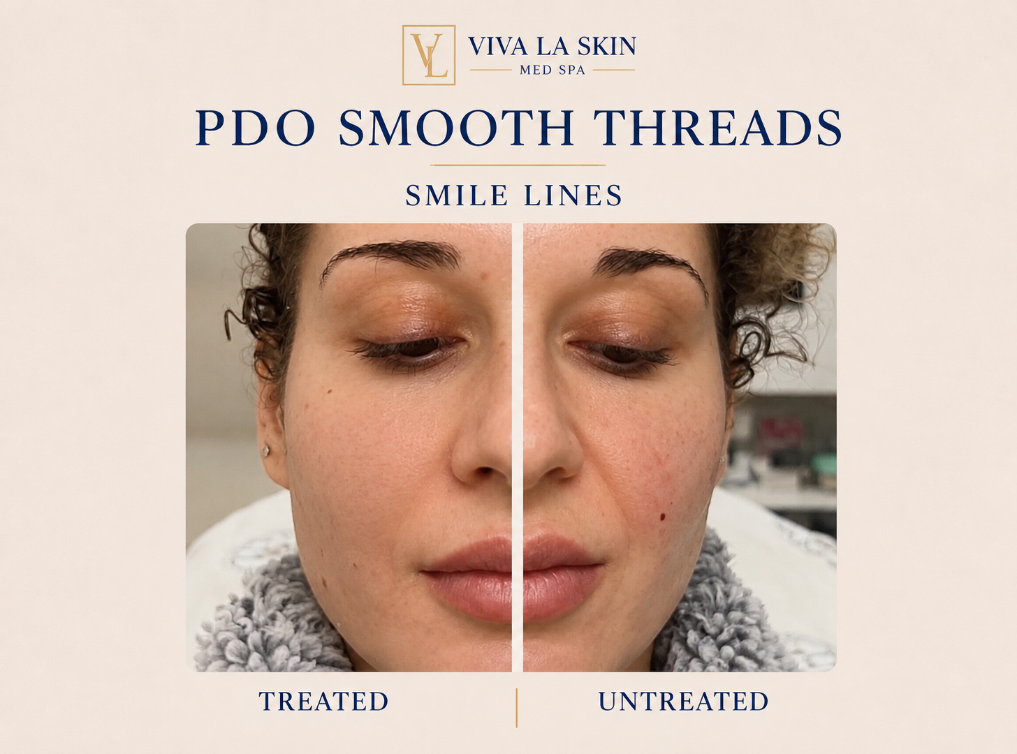 PDO Threads before and after result at Viva La Skin Med Spa in Myrtle Beach