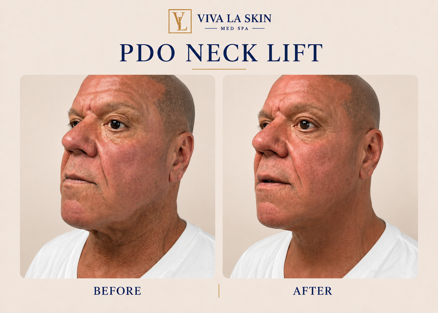 PDO Threads before and after result at Viva La Skin Med Spa in Myrtle Beach