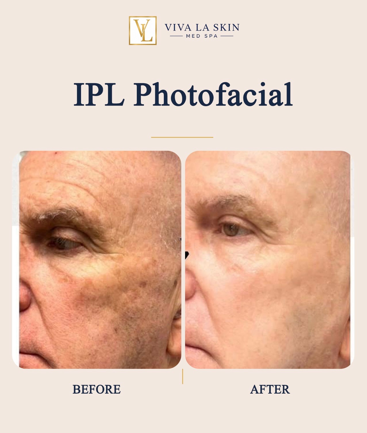 IPL Photofacial before and after result at Viva La Skin Med Spa in Myrtle Beach