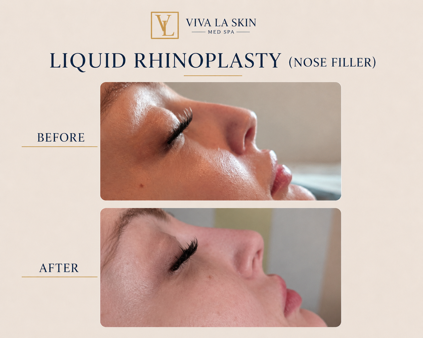 Filler before and after result at Viva La Skin Med Spa in Myrtle Beach
