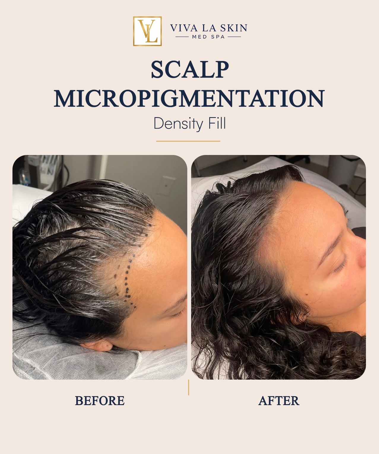 Scalp Micropigmentation before and after result at Viva La Skin Med Spa in Myrtle Beach