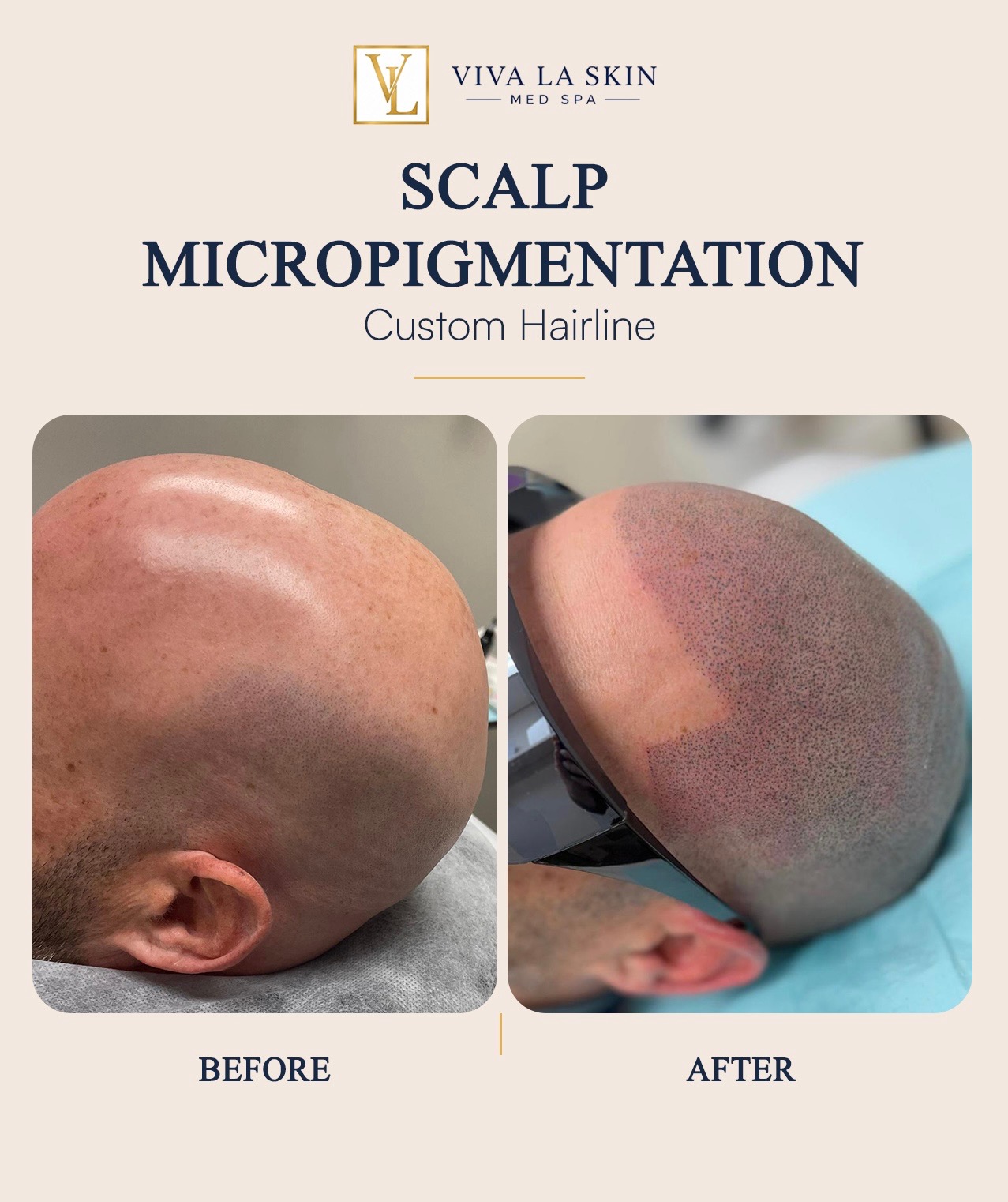 Scalp Micropigmentation before and after result at Viva La Skin Med Spa in Myrtle Beach