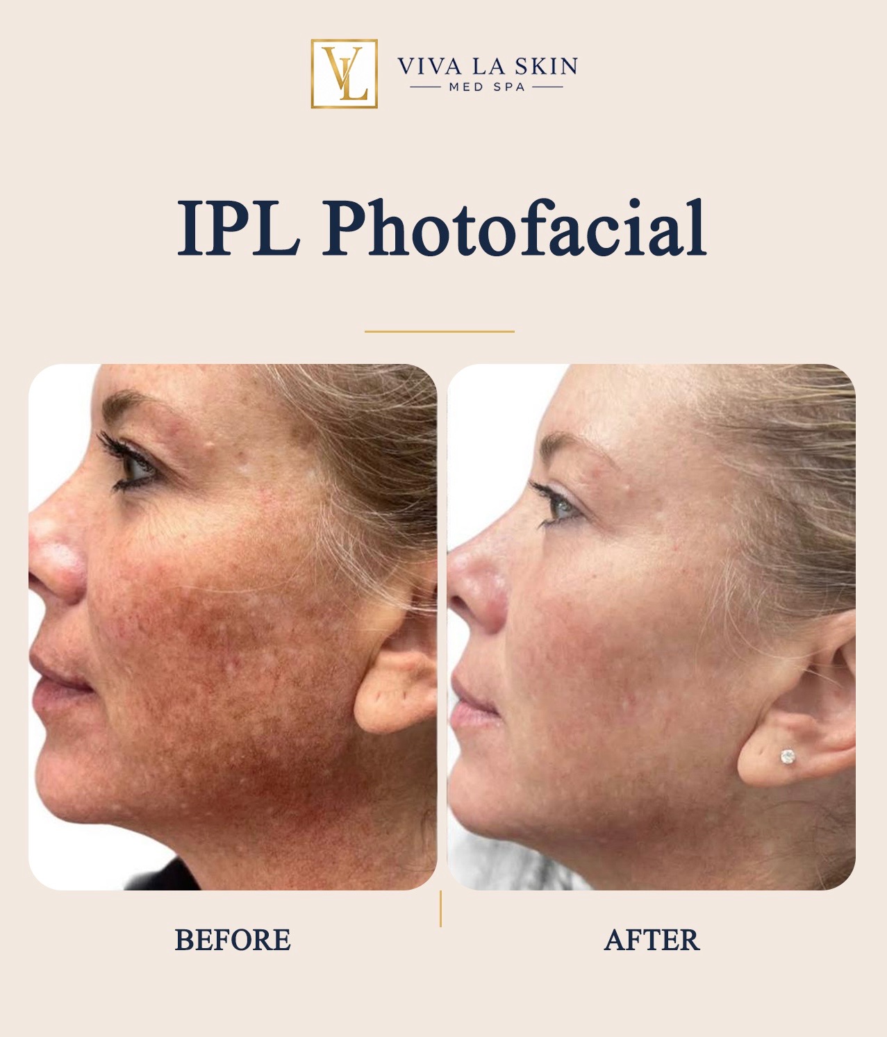 IPL Photofacial before and after result at Viva La Skin Med Spa in Myrtle Beach