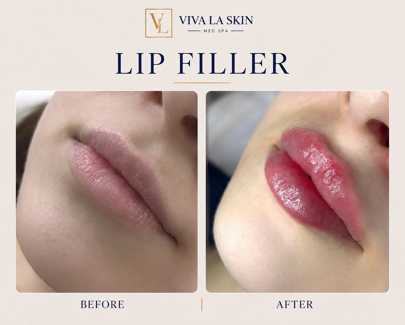 Filler before and after result at Viva La Skin Med Spa in Myrtle Beach