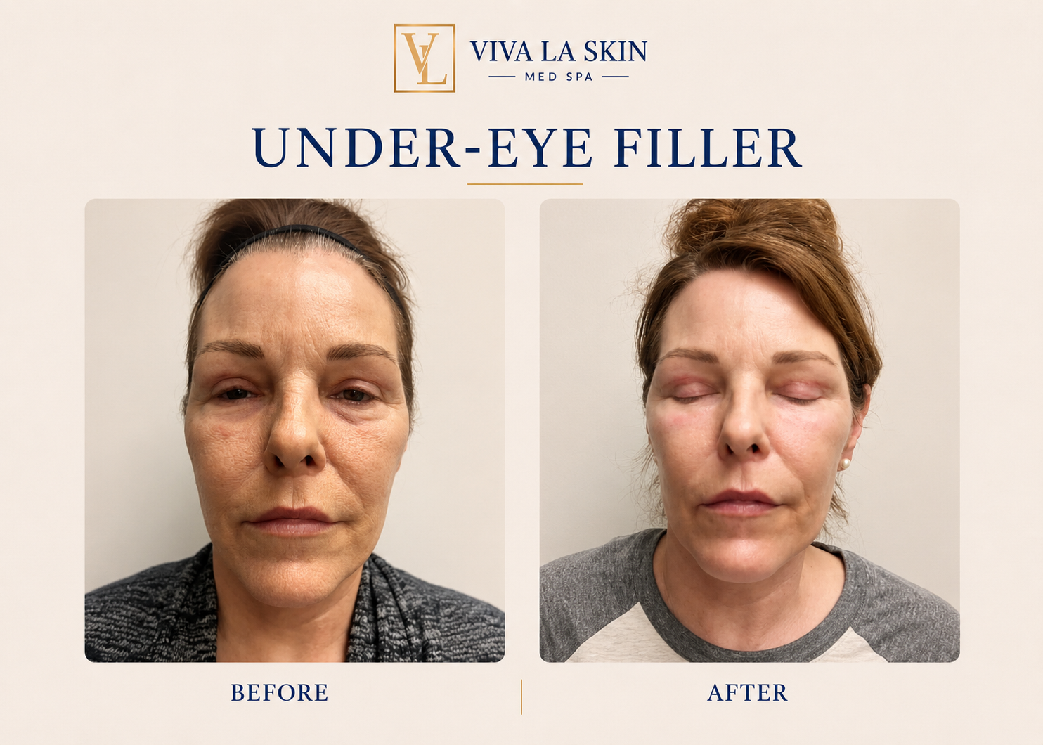 Filler before and after result at Viva La Skin Med Spa in Myrtle Beach