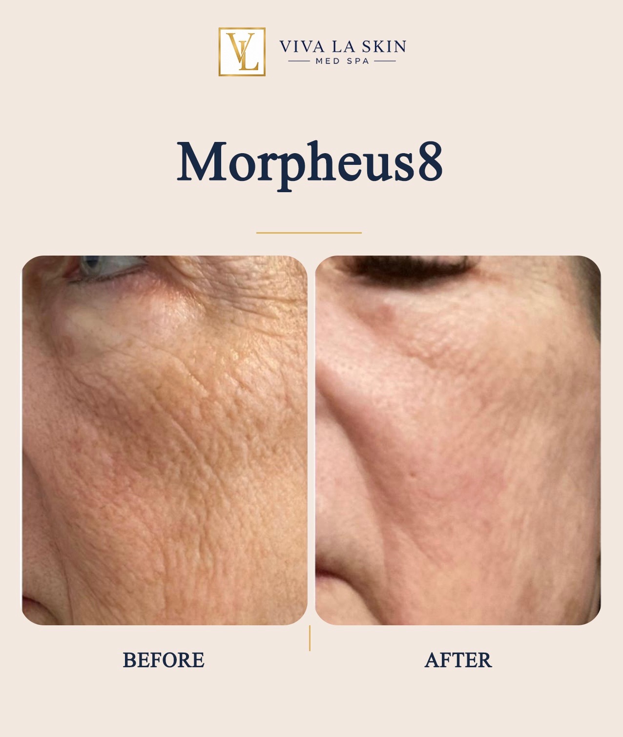 Morpheus8 before and after result at Viva La Skin Med Spa in Myrtle Beach