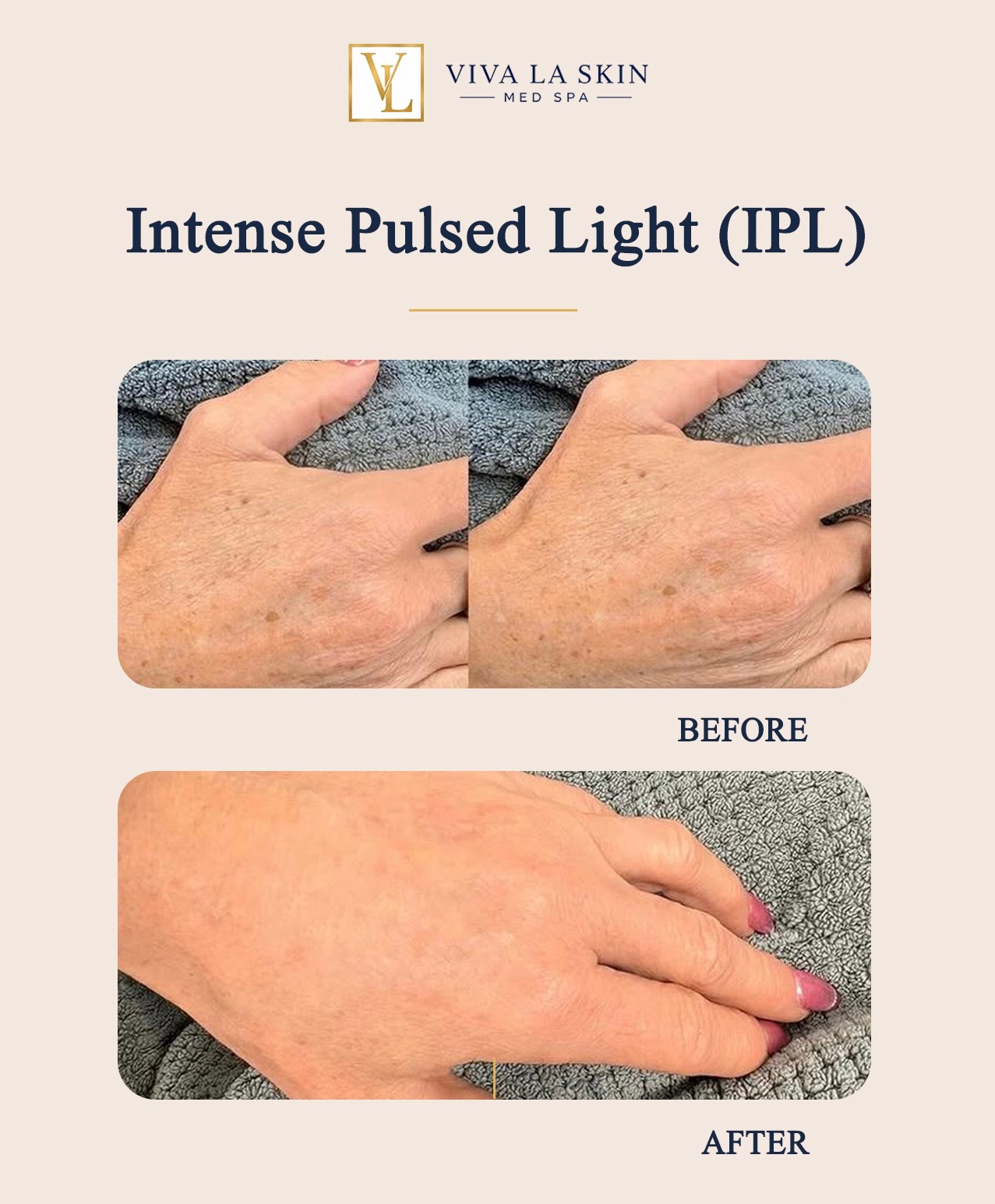 IPL Photofacial before and after result at Viva La Skin Med Spa in Myrtle Beach