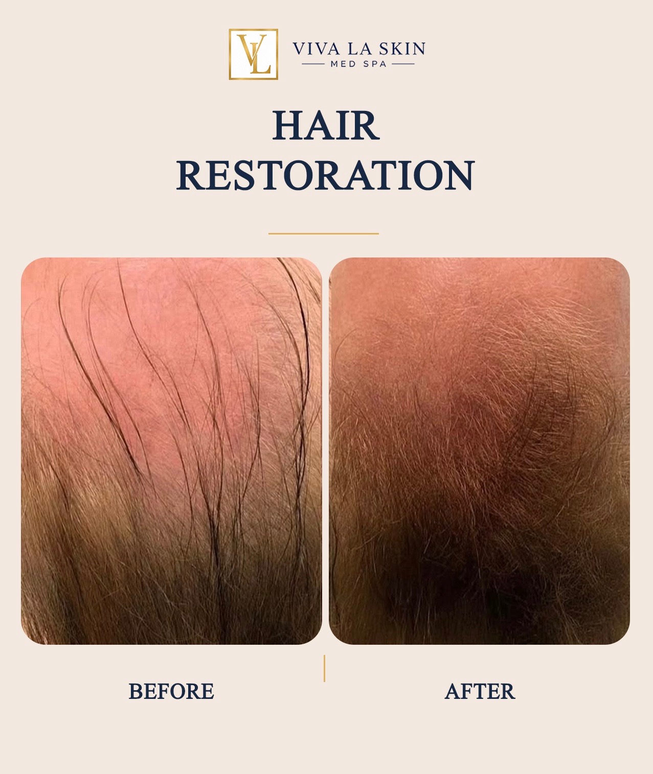 Hair Restoration before and after result at Viva La Skin Med Spa in Myrtle Beach