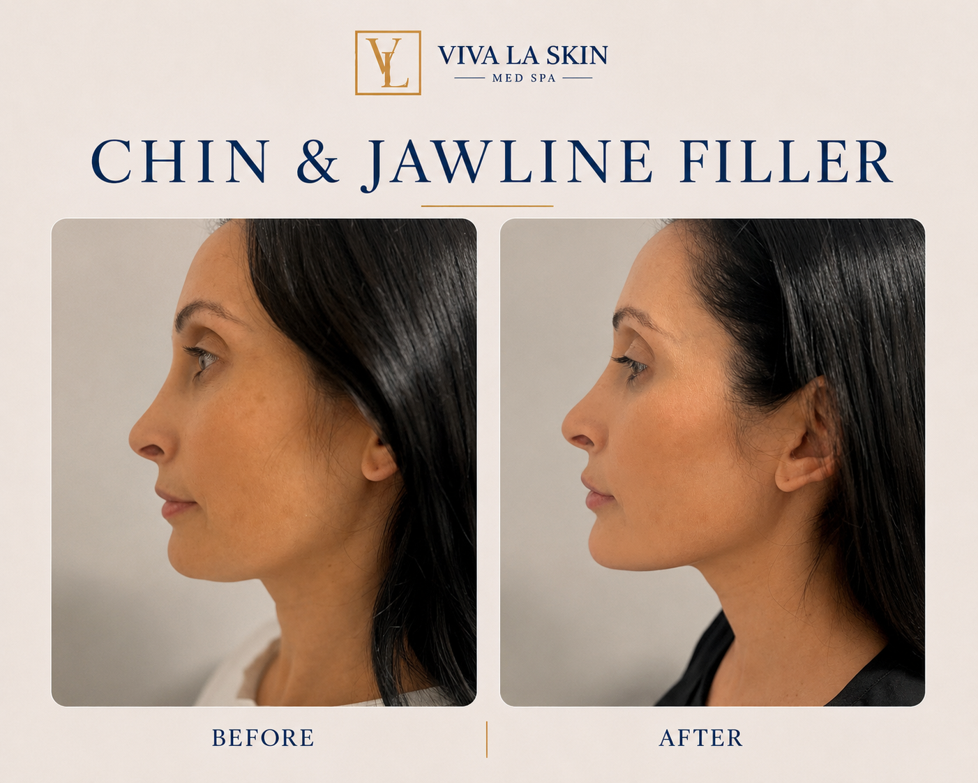 Filler before and after result at Viva La Skin Med Spa in Myrtle Beach