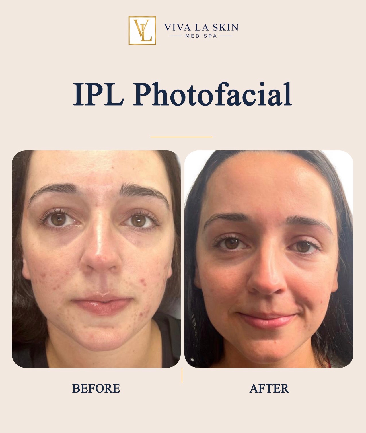 IPL Photofacial before and after result at Viva La Skin Med Spa in Myrtle Beach