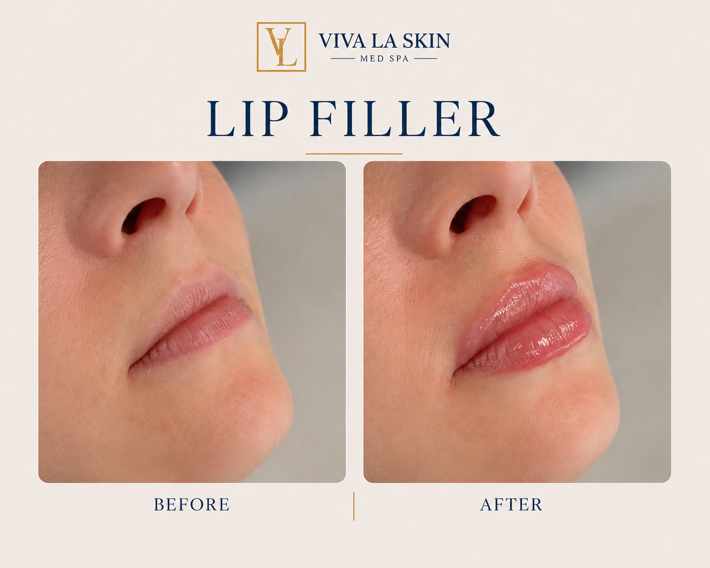 Filler before and after result at Viva La Skin Med Spa in Myrtle Beach