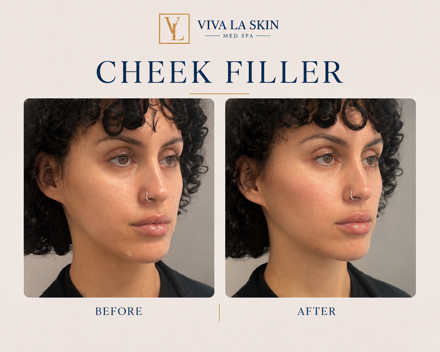 Filler before and after result at Viva La Skin Med Spa in Myrtle Beach