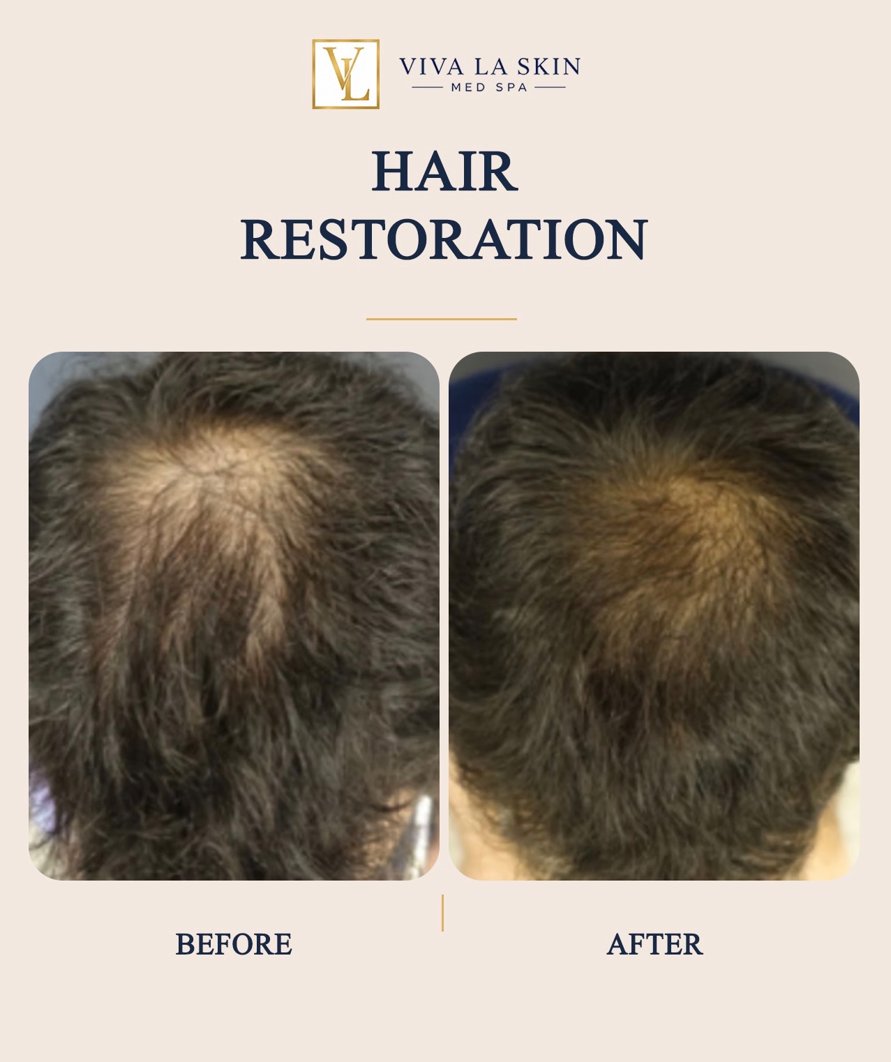 Hair Restoration before and after result at Viva La Skin Med Spa in Myrtle Beach