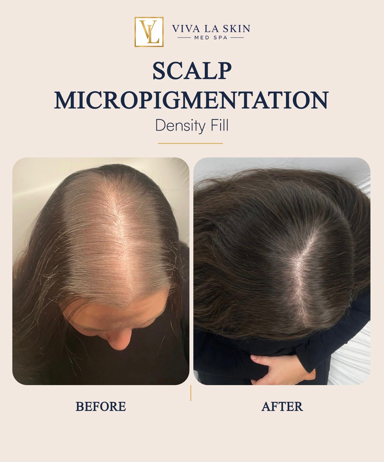 Scalp Micropigmentation before and after result at Viva La Skin Med Spa in Myrtle Beach
