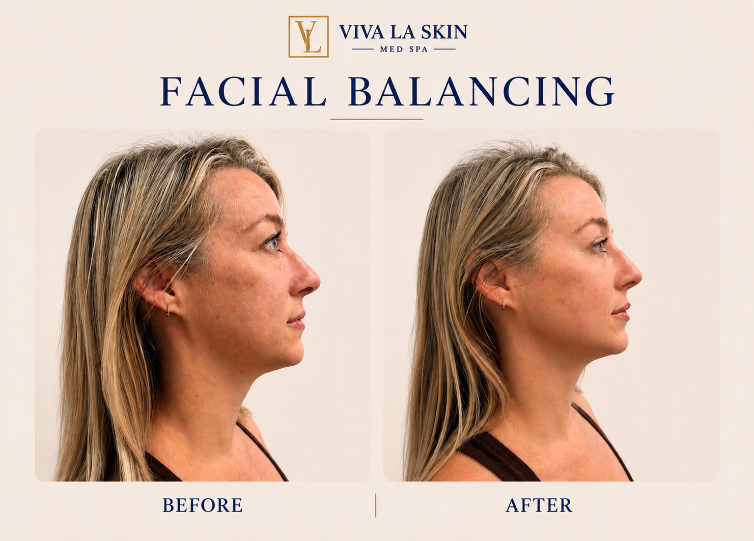 Facial Balancing before and after result at Viva La Skin Med Spa in Myrtle Beach