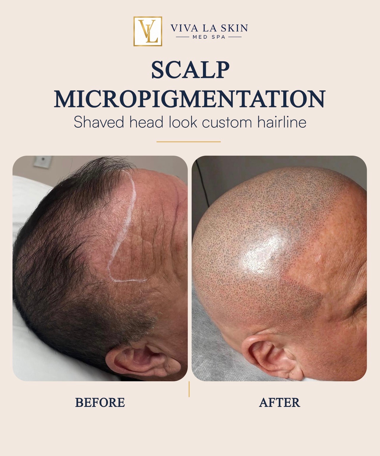 Scalp Micropigmentation before and after result at Viva La Skin Med Spa in Myrtle Beach