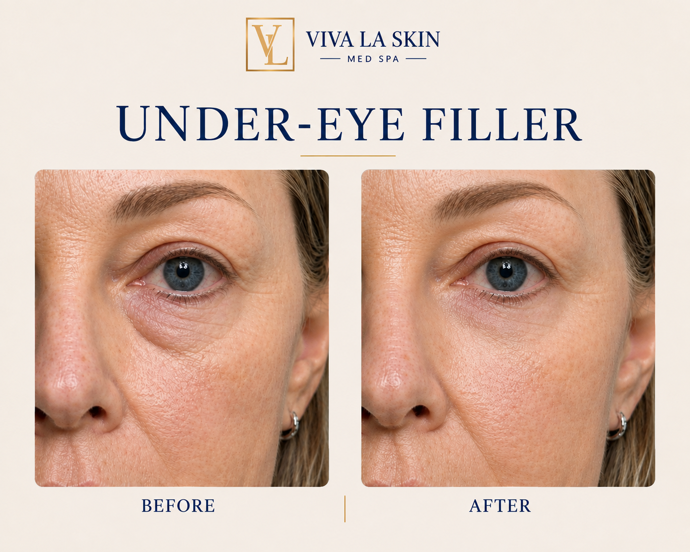 Filler before and after result at Viva La Skin Med Spa in Myrtle Beach