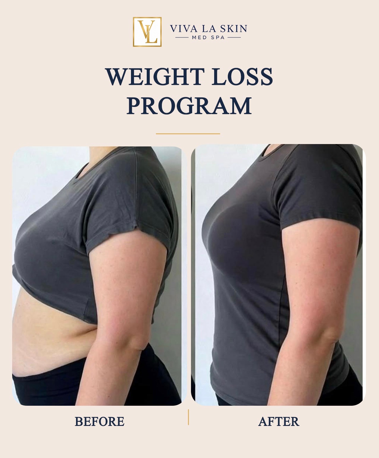Weight Loss Program before and after result at Viva La Skin Med Spa in Myrtle Beach